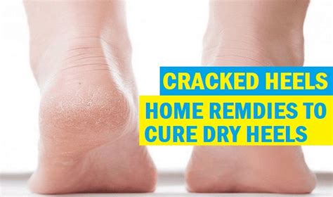 Why Nail Aid Magic Callus Remover is a must-have for your footcare routine